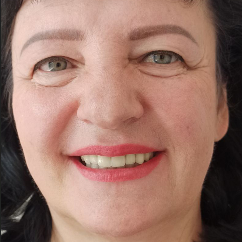 Імплантація – кейс 2