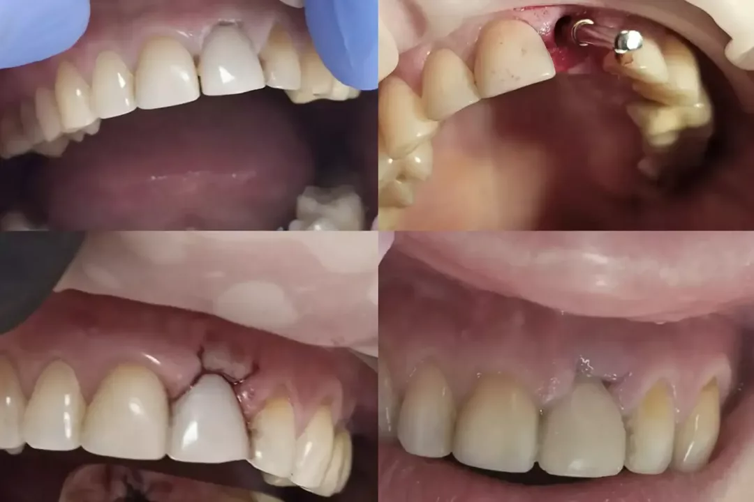 імплантація зубів