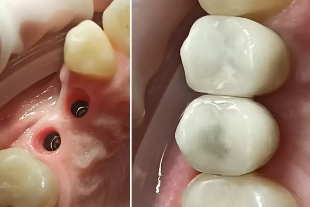 імплантація зубів