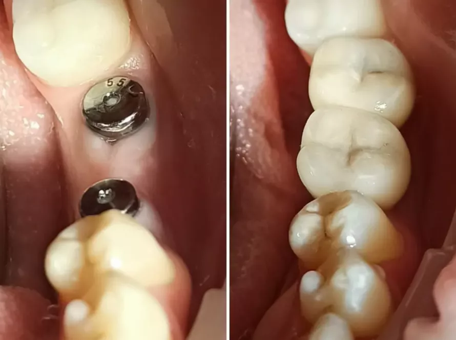 Імплантація зубів: що потрібно знати перед процедурою