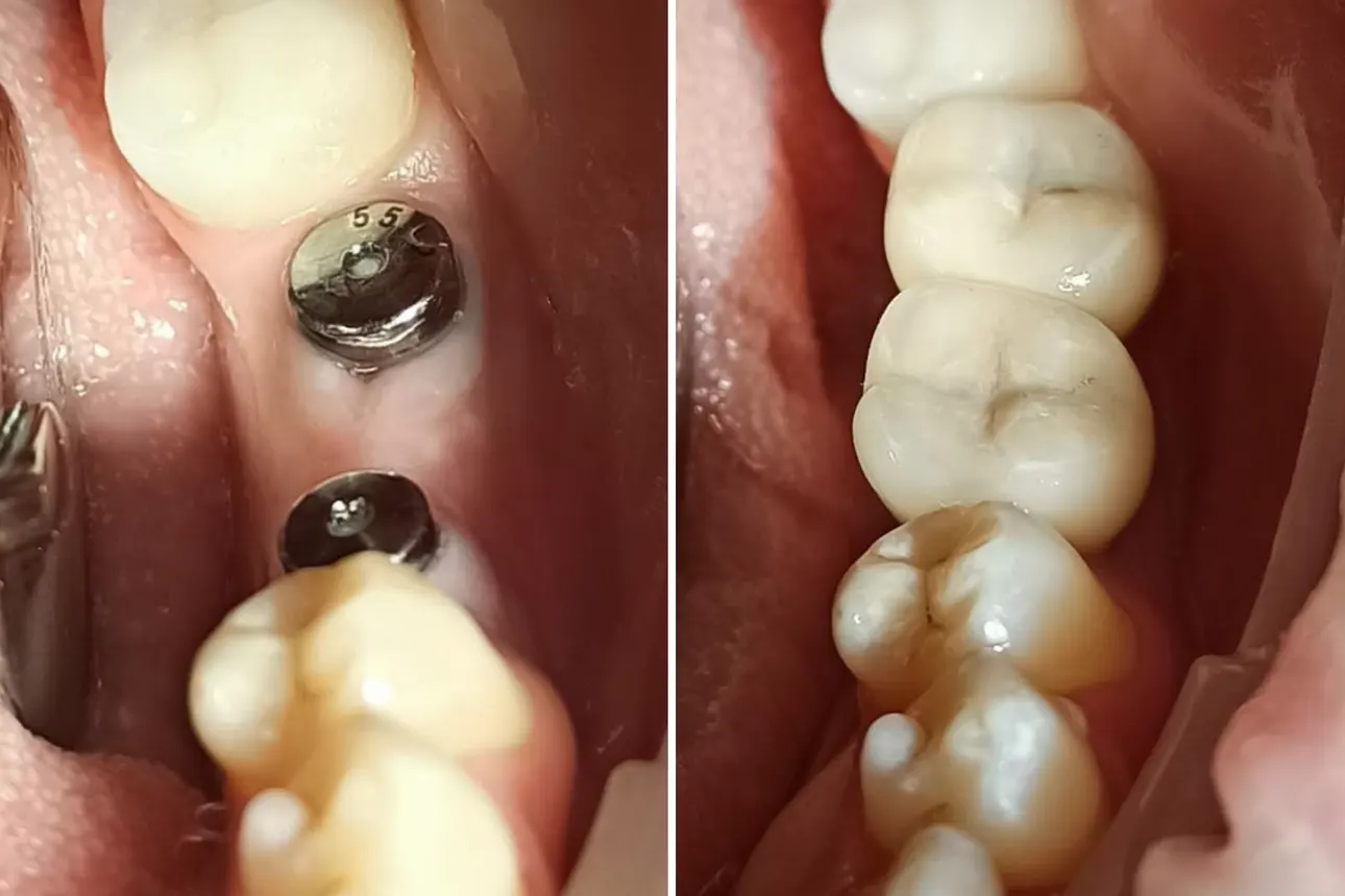 Імплантація зубів: що потрібно знати перед процедурою