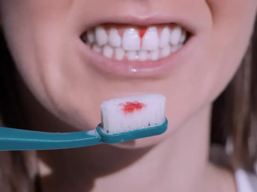 кровоточивість ясен