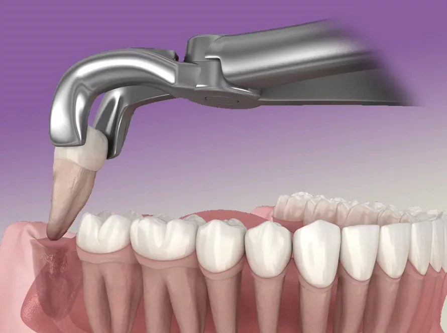 Видалення зуба мудрості