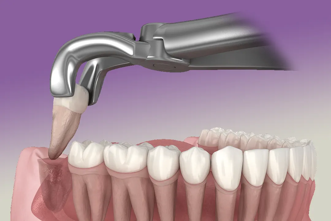 Видалення зуба мудрості