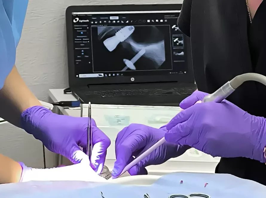 імплантація зубів