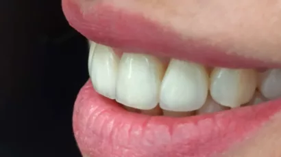 Керамічні вініри