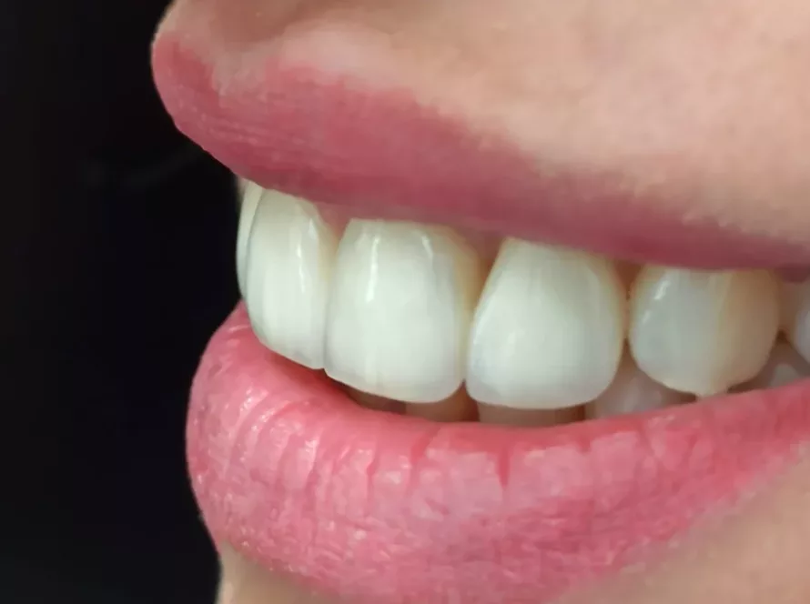 Керамічні вініри