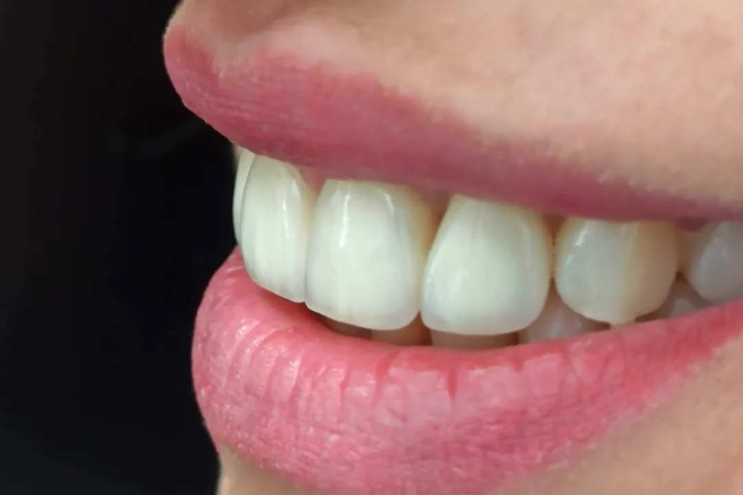 Керамічні вініри