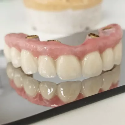 протезування на імплантах all on 4