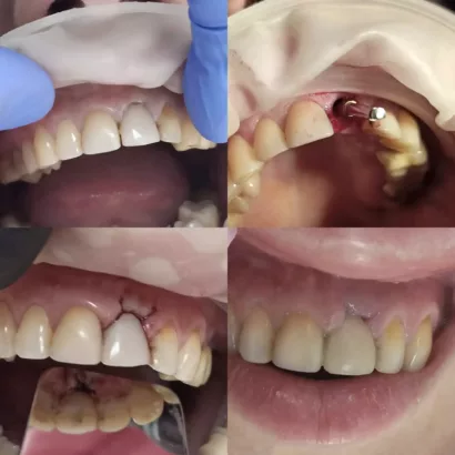 Імплантація переднього зубу