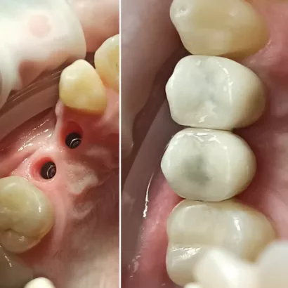 Відсутність або зруйнованість одного або декількох зубів.