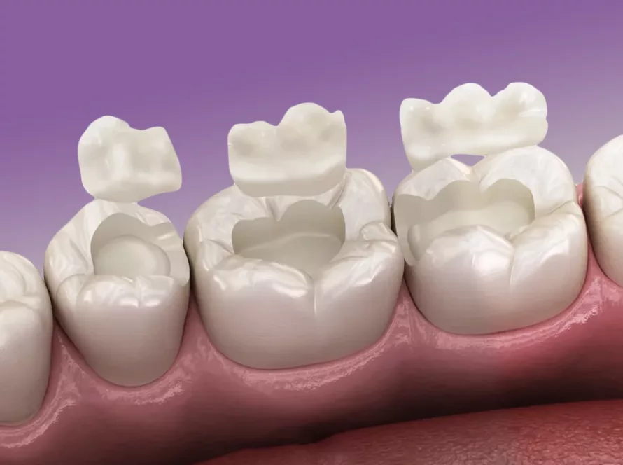 Вкладка як альтернатива пломбам