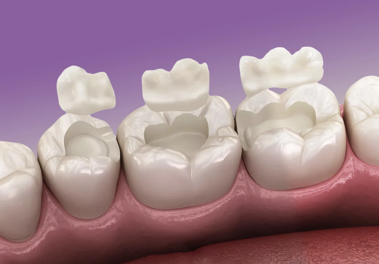 Вкладка як альтернатива пломбам