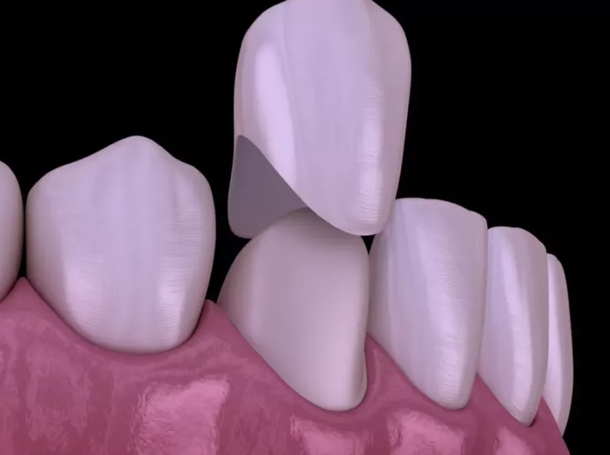 Керамічна коронка на зуб