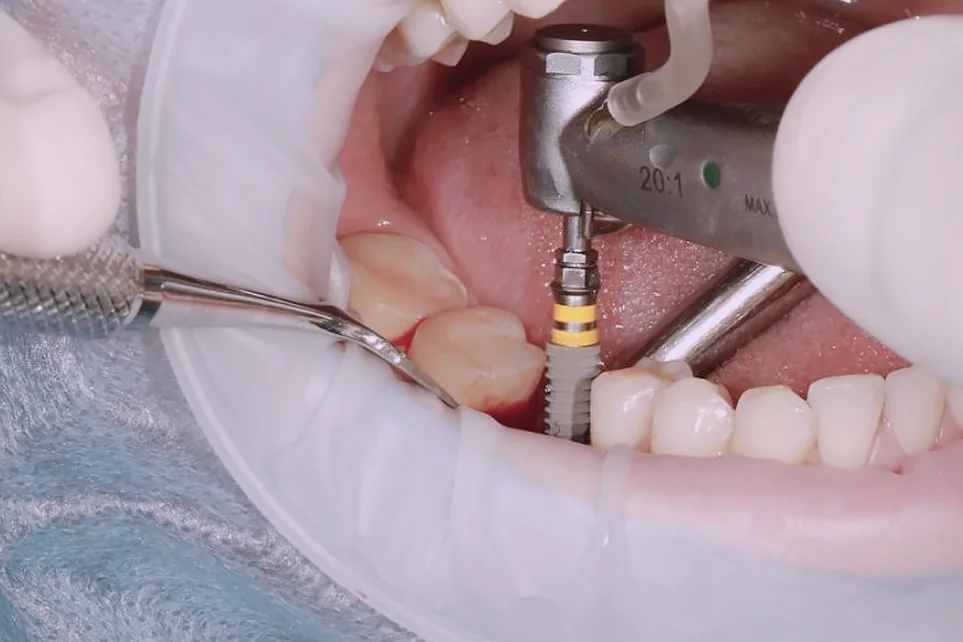 Встановлення зубних імплантів