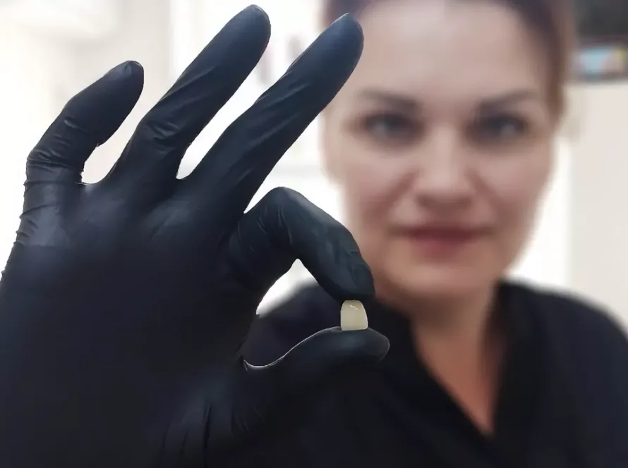 Керамічний вінір