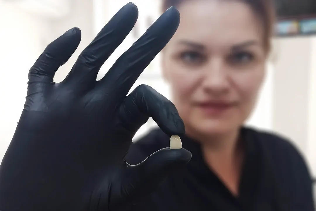 Вінір керамічний