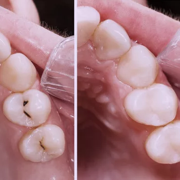 лікування карієсу