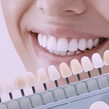 Послуги відбілювання зубів в клиніці Формула 1