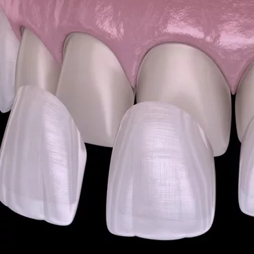 Встановлення вінірів в клініці Формула 1