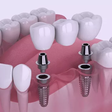 Послуги имплантації зубів в клиніці Формула 1