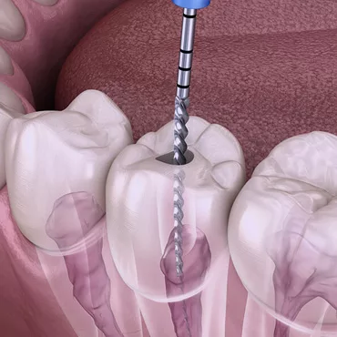 лікування каналів зубів
