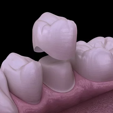 Коронка зуба